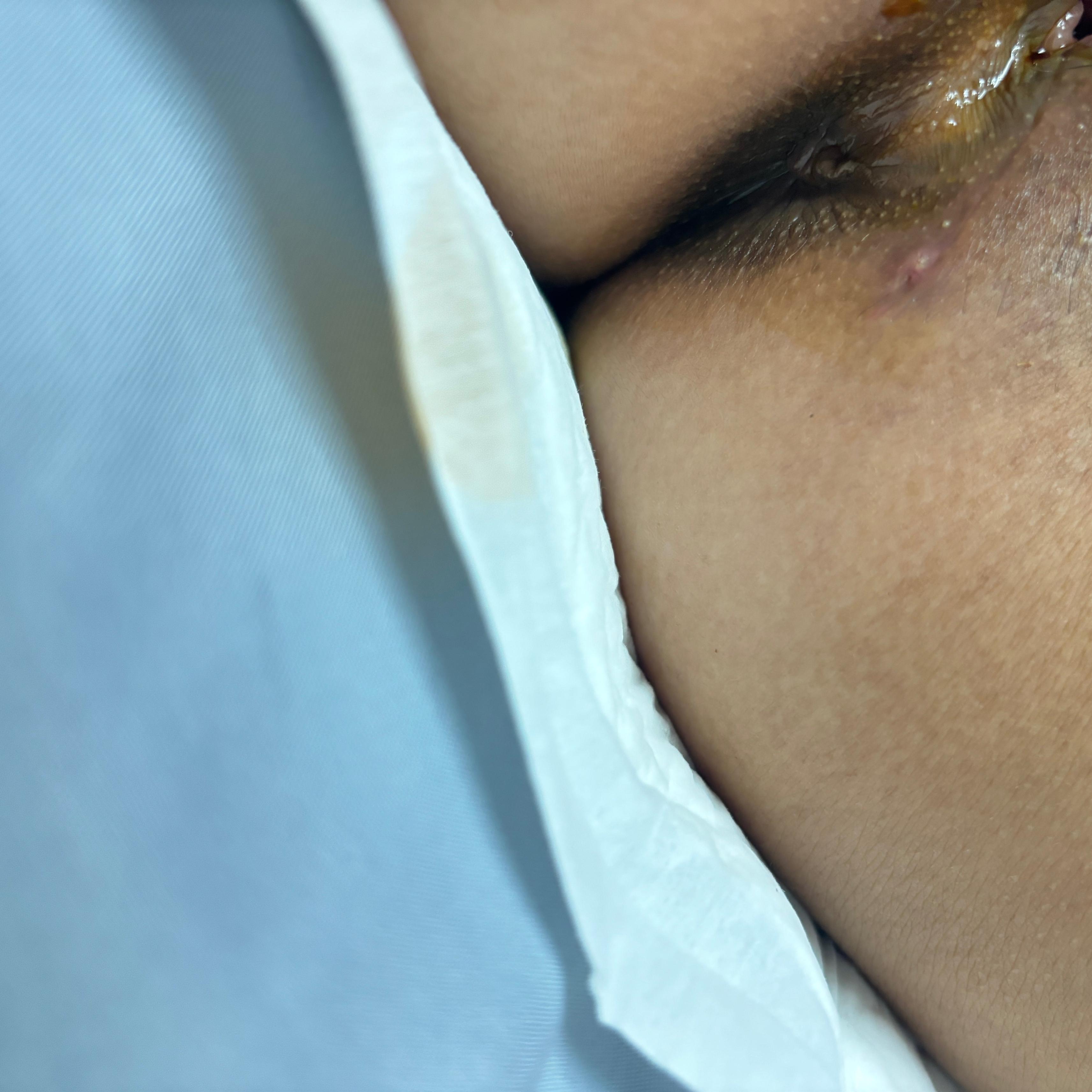 22岁骚货孕妇顺产，骚穴被剪开恢复全过程[22P]